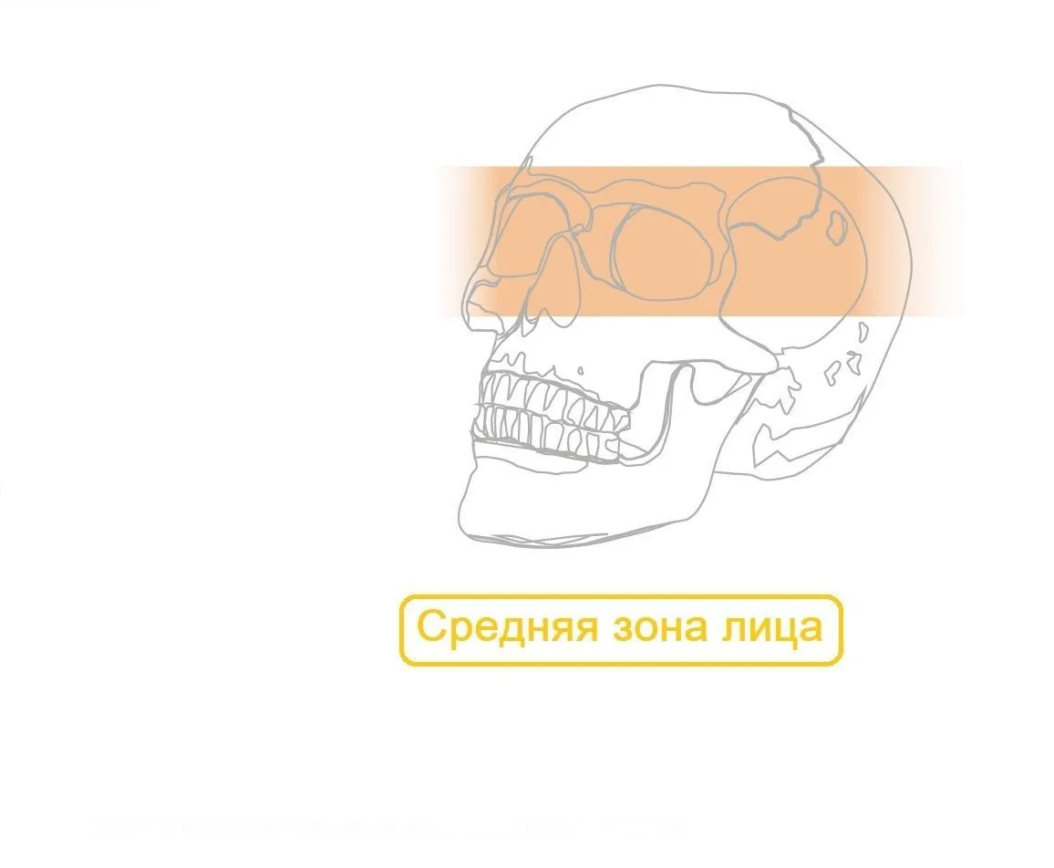 Средняя зона Пластины Миди для дна глазницы