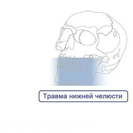 Трамва Нижней Челюсти Пластины Мини
