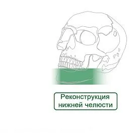 Реконструкция Нижней Челюсти Пластины Макси